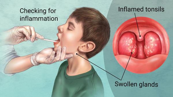 drainage tonsils Sinus in adults throat